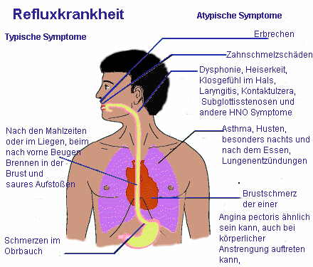 Symptome der Refluxkrankheit